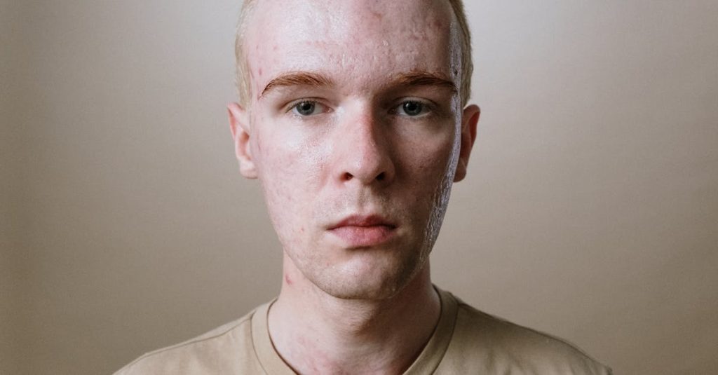 découvrez des conseils efficaces pour comprendre et traiter l'acné. apprenez les causes, les solutions et les bonnes pratiques pour retrouver une peau saine et éclatante.